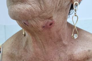 7 Side Effects of Endolift Laser Treatment: What You Need to Know