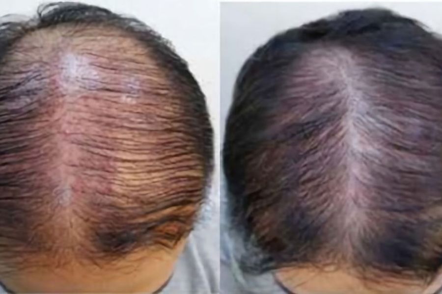 Can Polynucleotide Treatment Really Help with Hair Loss?