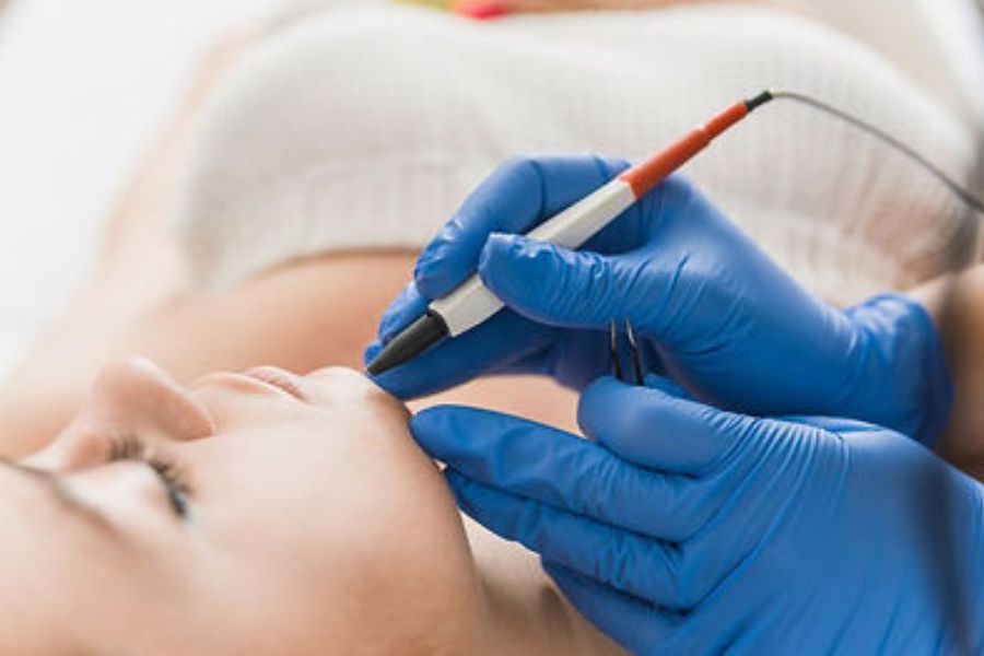 Laser Hair Removal vs. Electrolysis: Which is Better in London?