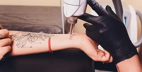 Laser Tattoo Removal Near You