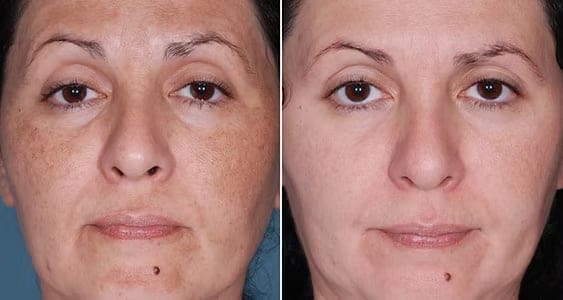Power of OBAGI Blue Peel Radiance