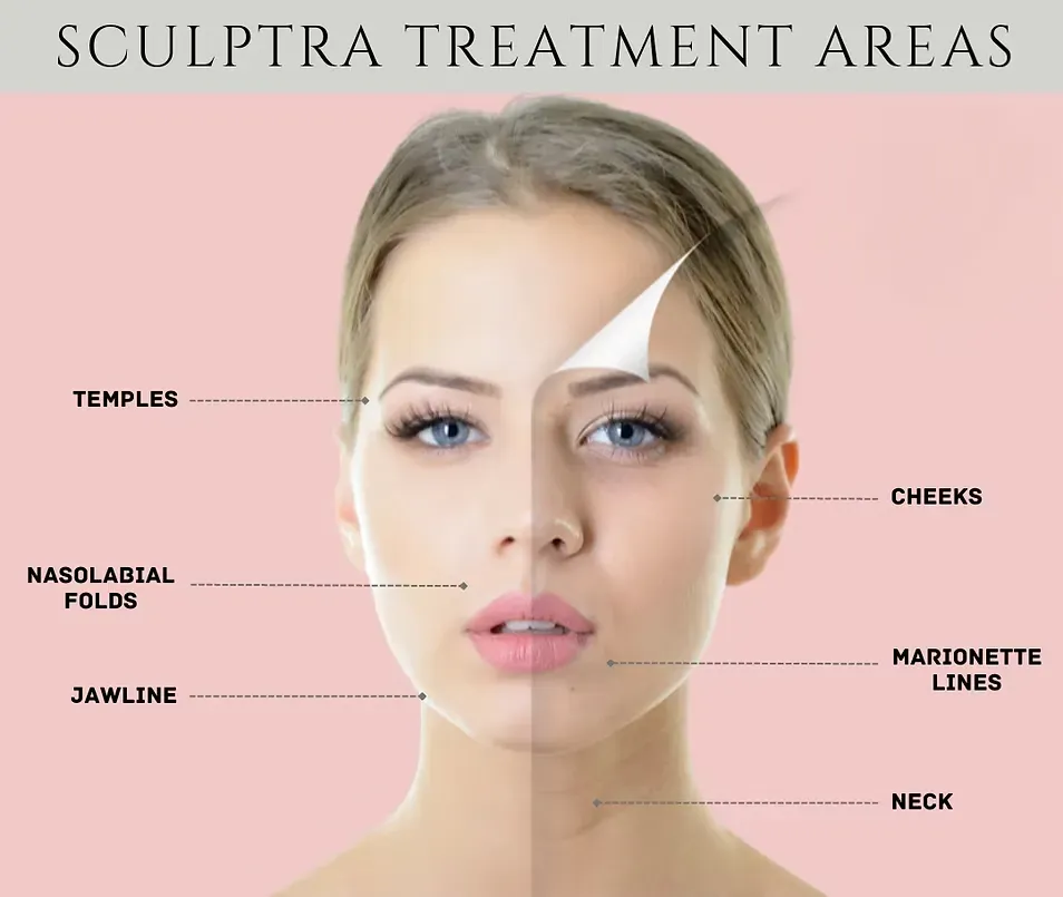 Sculptra Filler for Face
