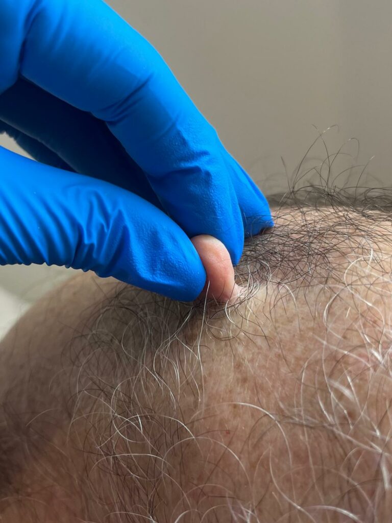 Skin Tag Removal