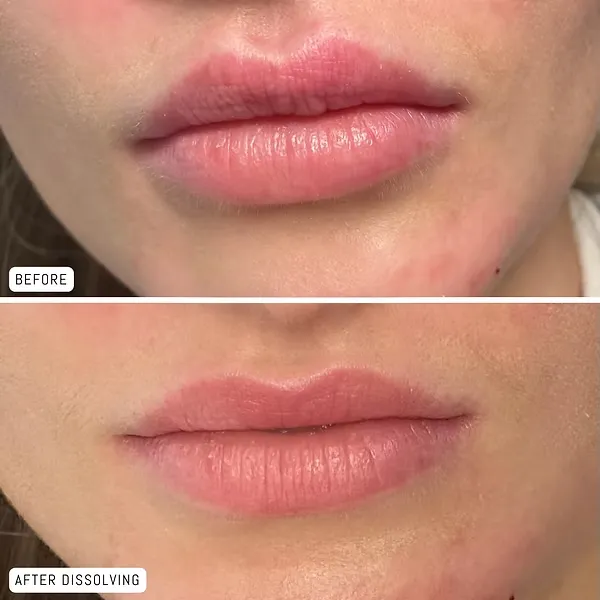 Dermal Filler Dissolving