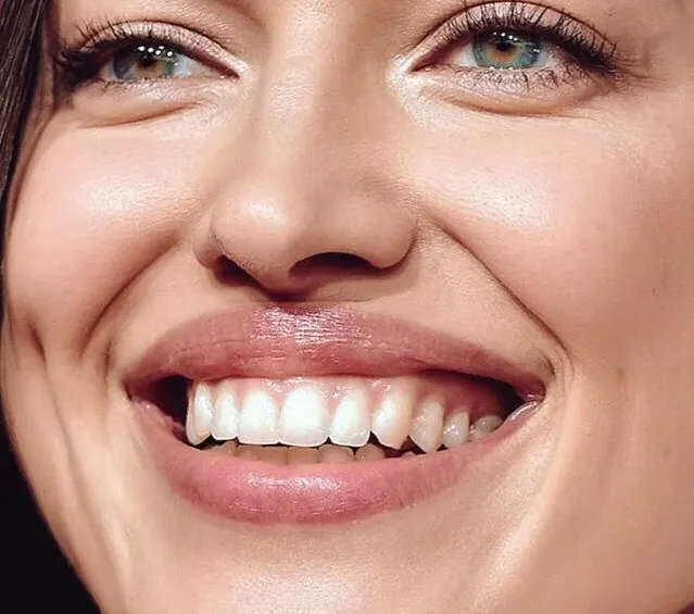 Botox for Gummy smile