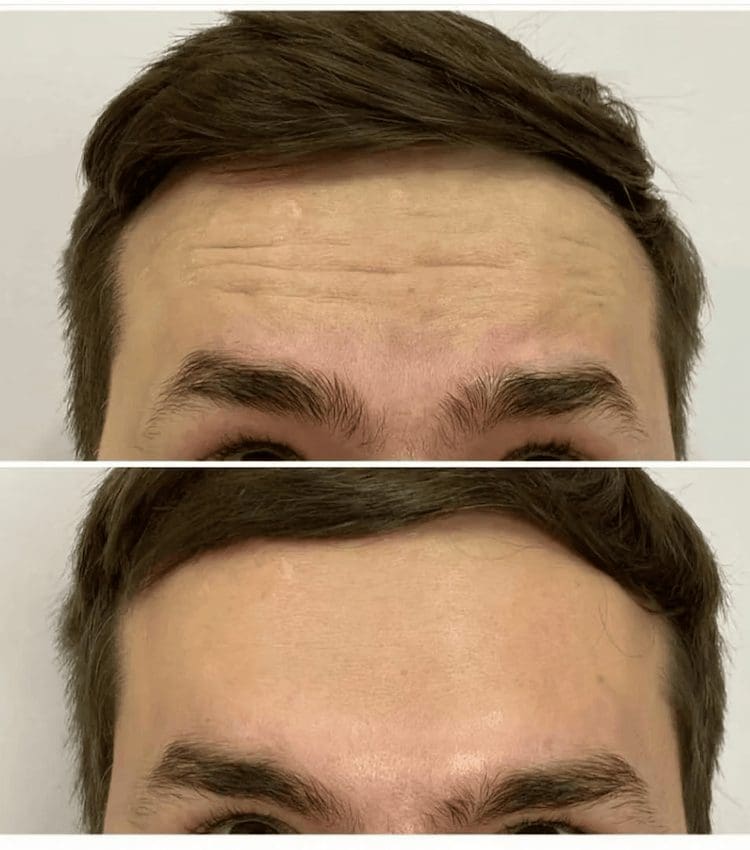 Anti-Wrinkle Treatments for Men