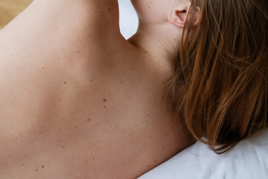 Wart Removal
