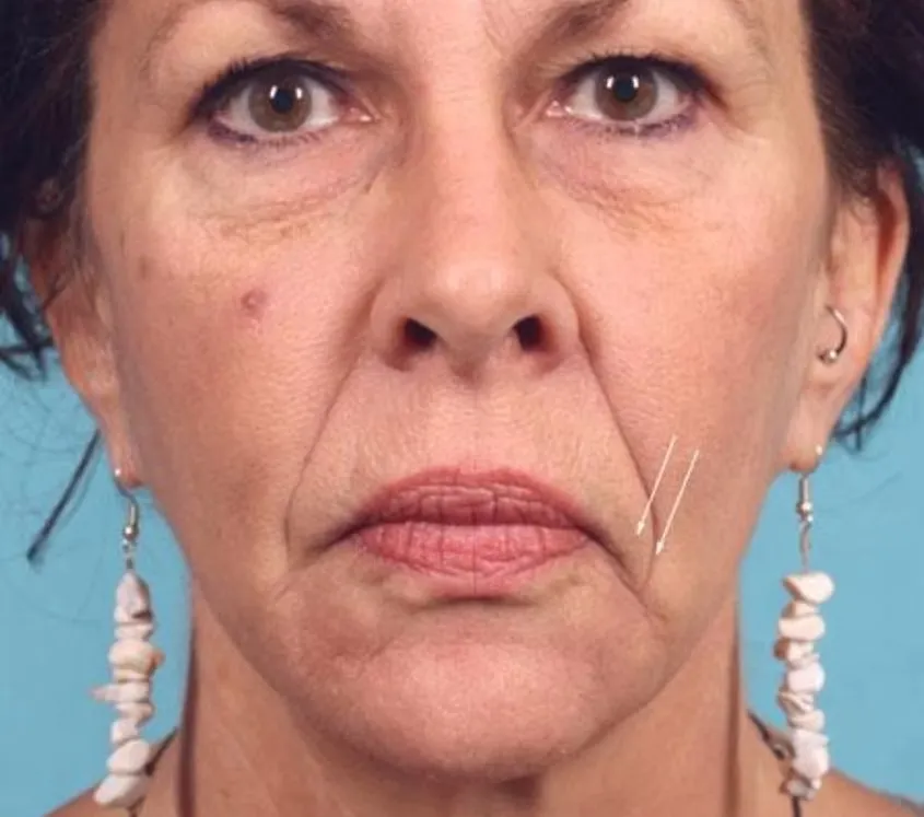 Corner of Mouth Lift