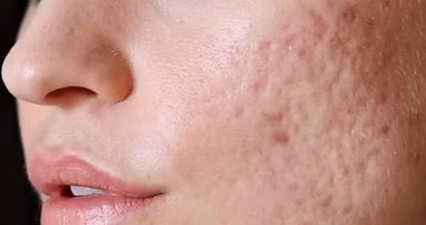 Acne Scarring