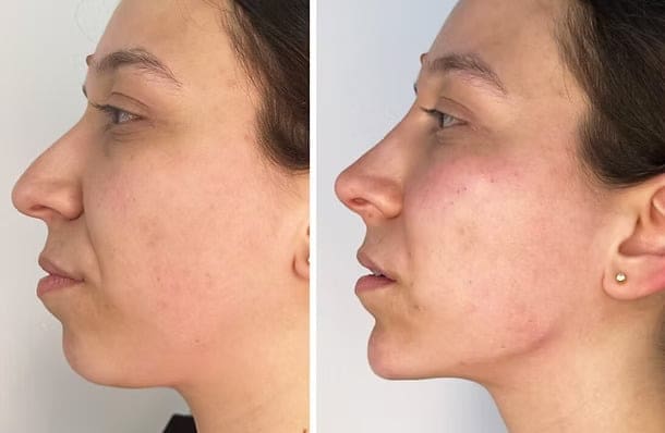 Endo Laser Lift