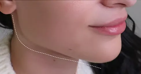 Jawline Filler