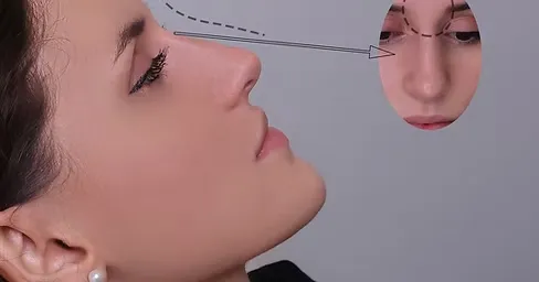 Nose Filler