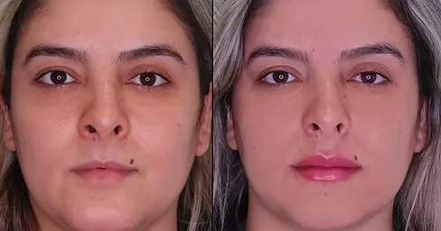Lip Fillers
