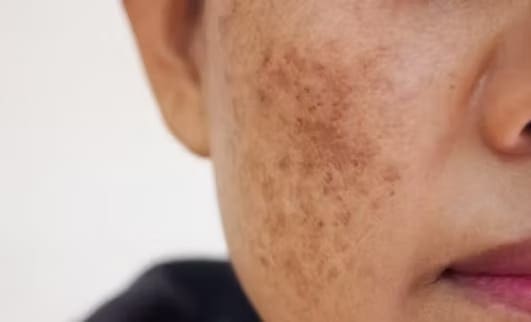 Melasma and Facial Hyperpigmentation