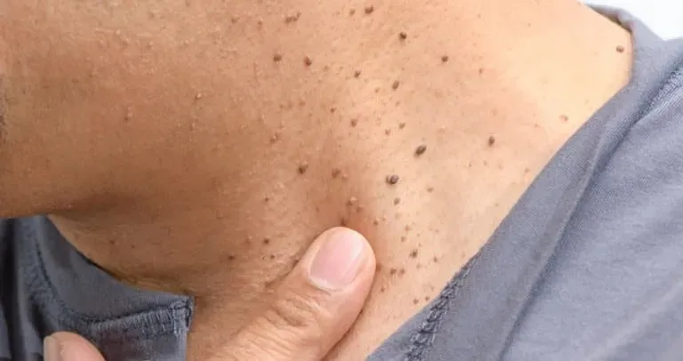 Moles Skintags Lump warts