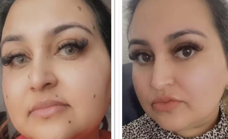 Moles and their reduction