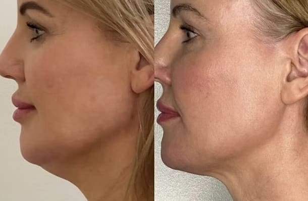 PDO Threads Neck lift