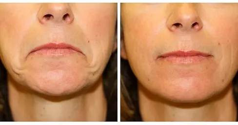 Corner of Mouth Lift