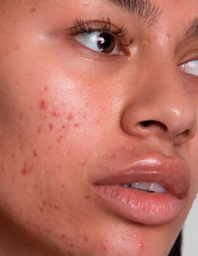 Melasma and Facial Hyperpigmentation