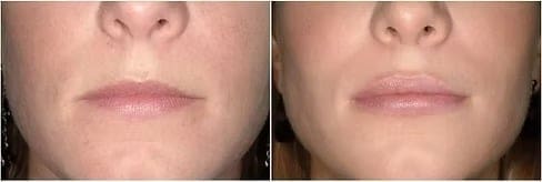 Lip Flip Botox
