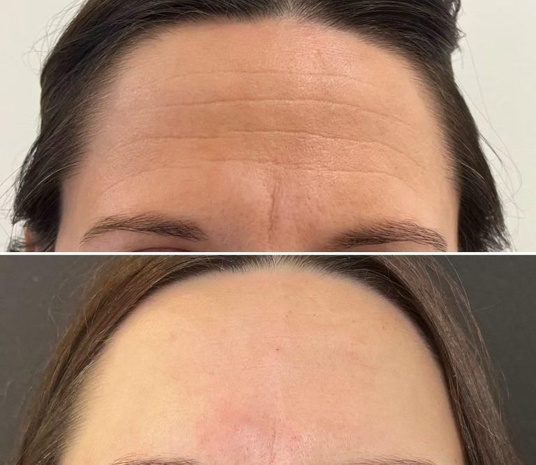 Anti-Wrinkle Injections 3 Areas