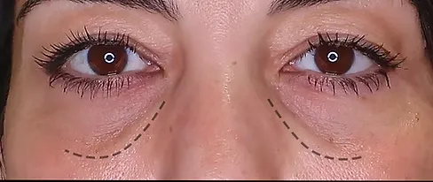 Tear Trough Filler
