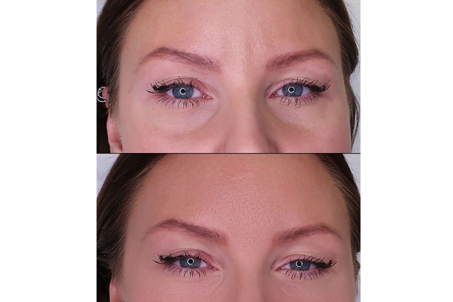 Dark Circles Under Eye: Polynucleotide Treatment Available Near You!