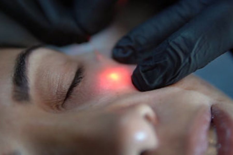 Best Endolift for Eyebags