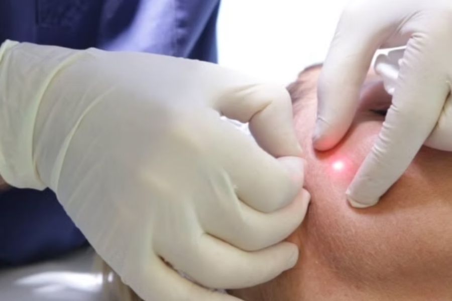 Endolift Laser Facelift Review