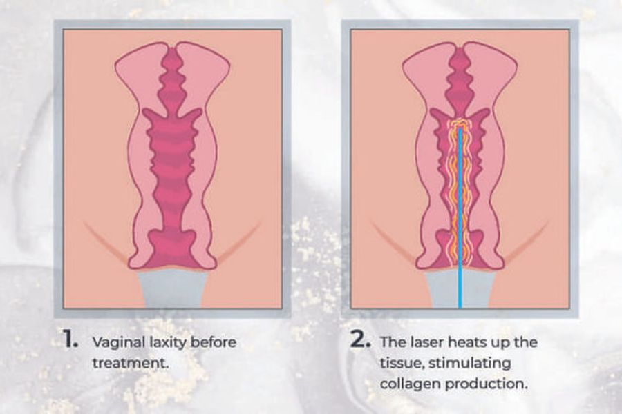 How to Tighten Your Vagina Naturally with Laser Vaginal Tightening and the PRP Vaginal Rejuvenation