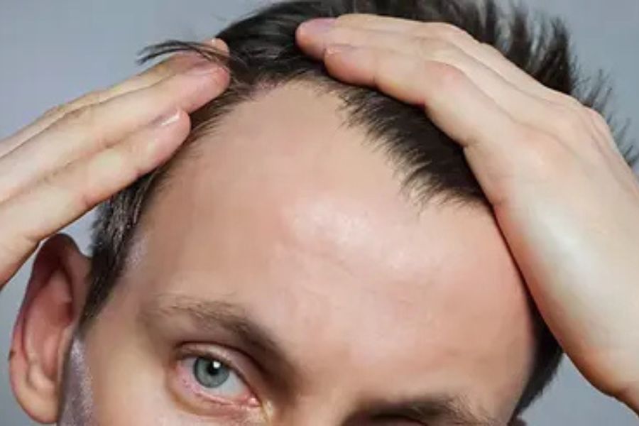Polynucleotides for Hair Loss Review