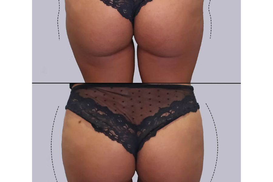 Discover the Sculptra Butt Lift