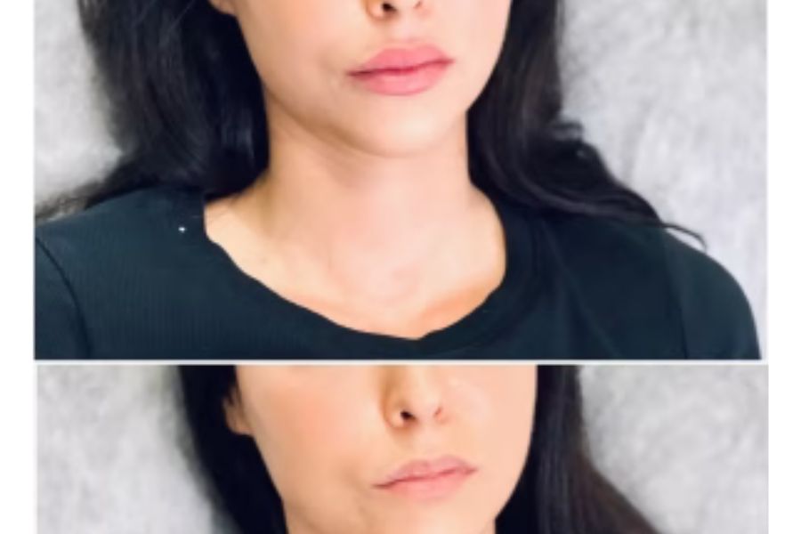 Is Lip Augmentation still on trend?