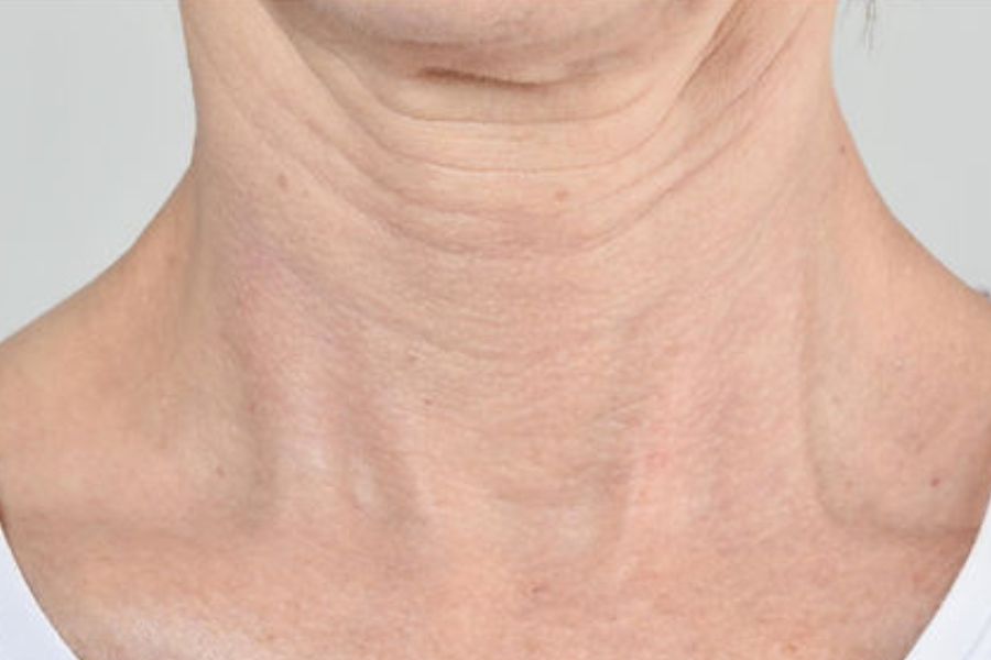 Polynucleotides for Neck Wrinkles in London – A Promising Approach to Combat Skin Ageing