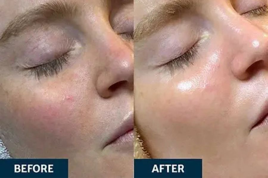Best HydraFacial in Greenwich