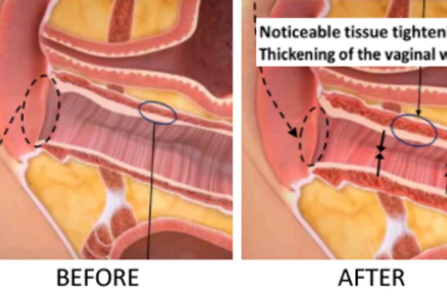 Best Vaginal Tightening Treatments | CO₂ Laser & PRP Vaginal Rejuvenation | Skinoza Clinic London