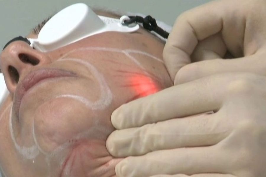 Best Non-Surgical Facelift in Kent – Endolift Skinoza