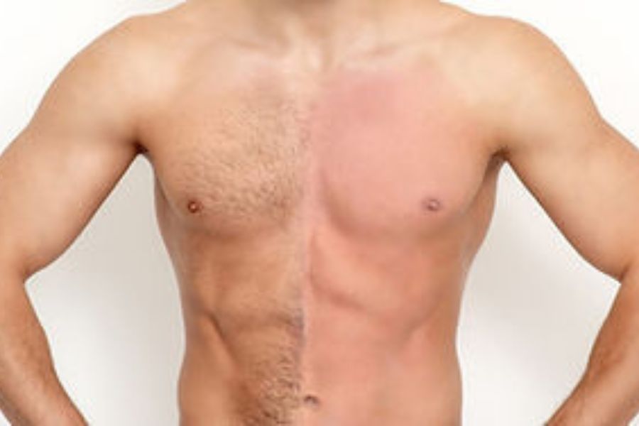 Male hair removal in London: Laser, Electrolysis, and Waxing?