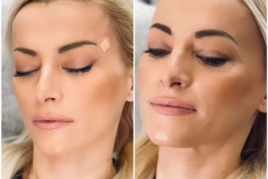 What is a Face Thread Lift?