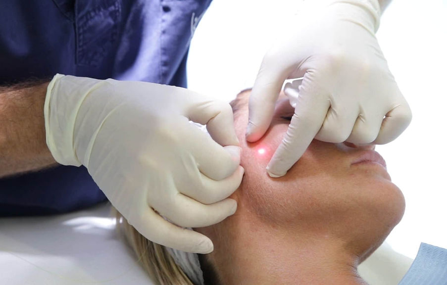 Understanding Endolift: Side Effects and What to Expect