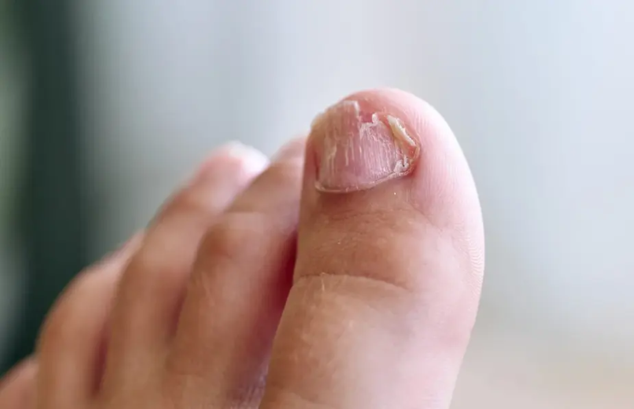 Decoding the Mystery in Greenwich: Does Laser Fungal Nail Treatment Truly Work?