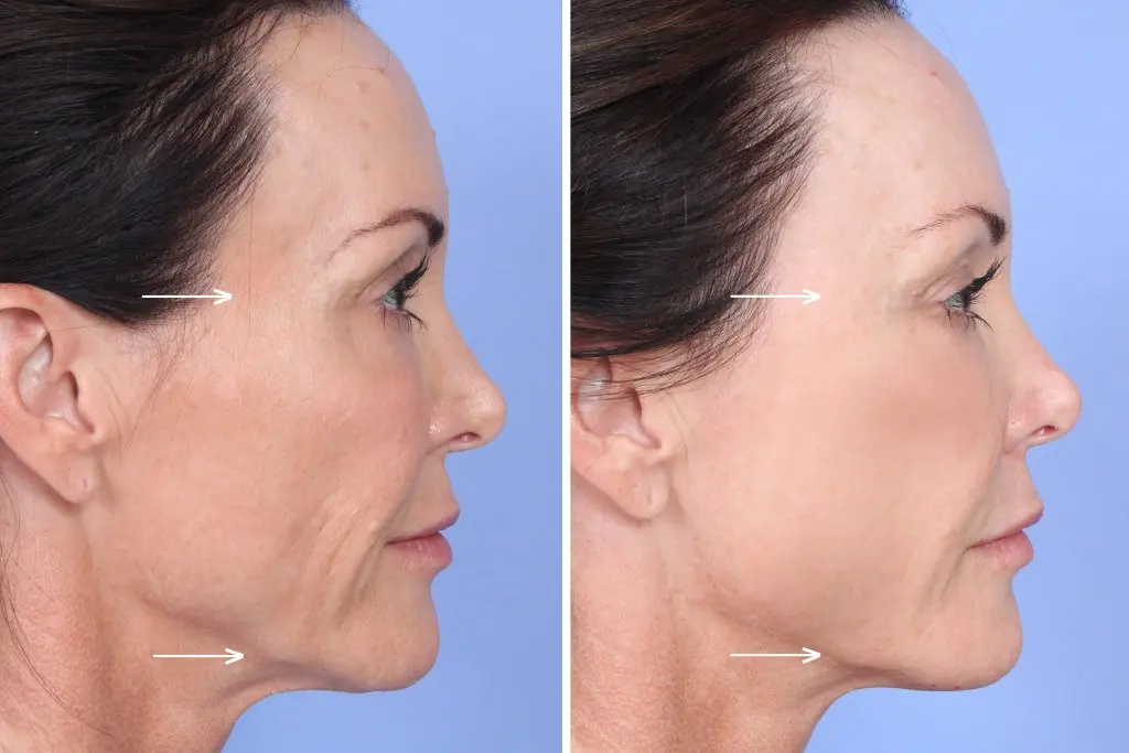 Sculptra Filler for Face