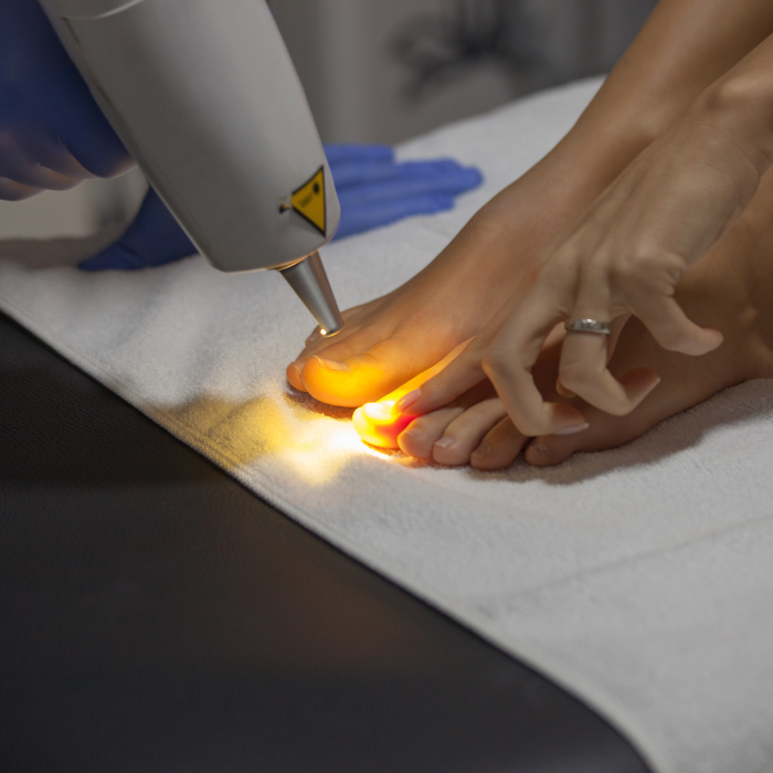 Fungal Nail Laser Treatment