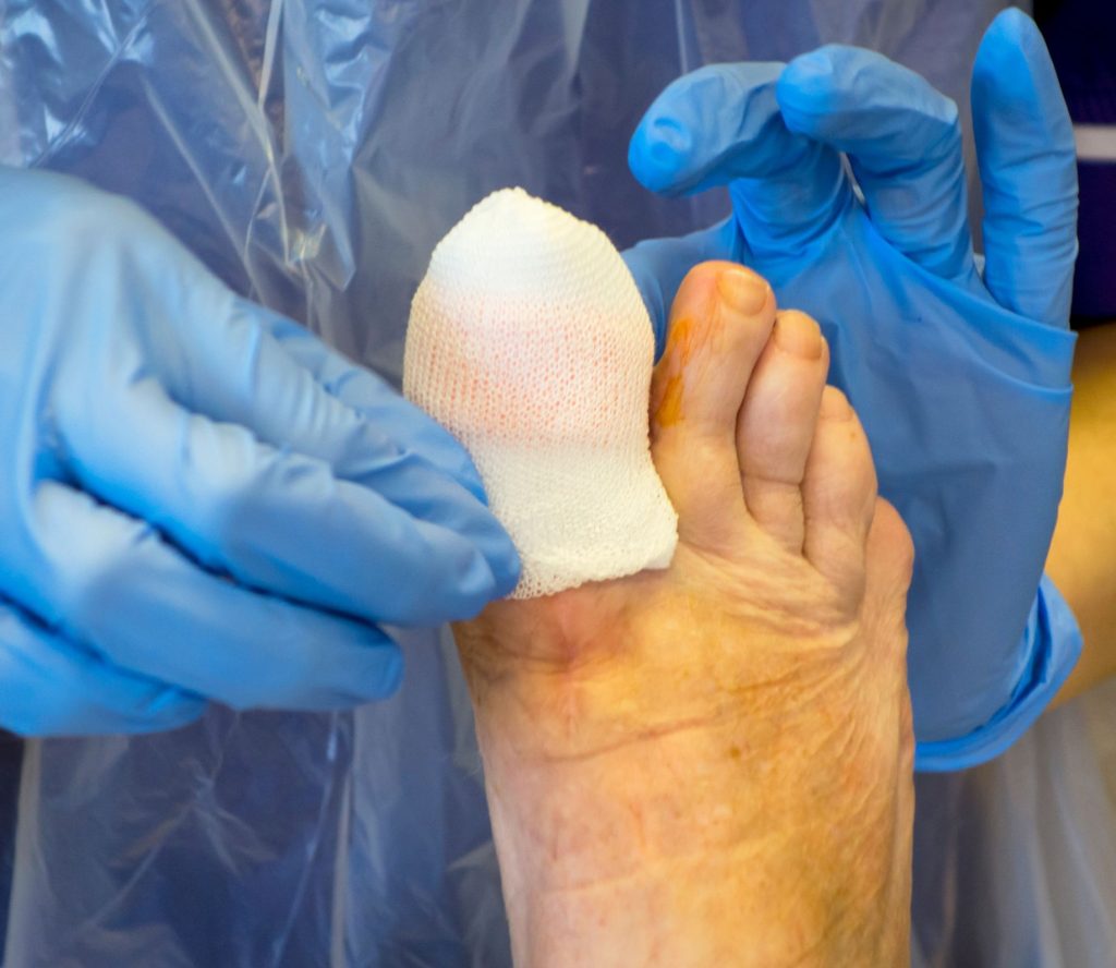 Toenail Surgery
