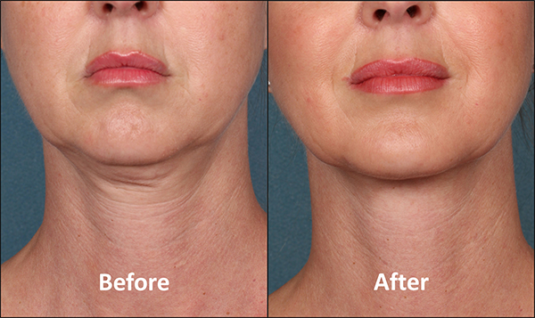 Sculptra for Neck Rejuvenation in the UK