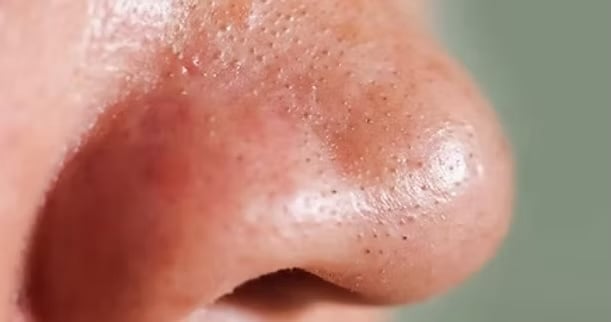Blackheads 1