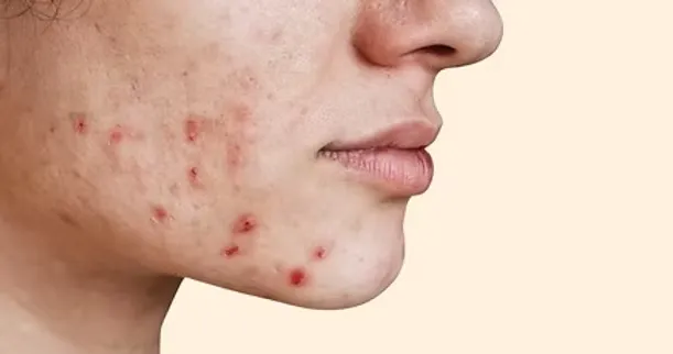 Breakouts and Acne 2