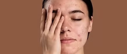 Breakouts and Acne 3