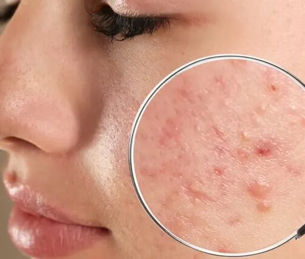 Breakouts and Acne 5
