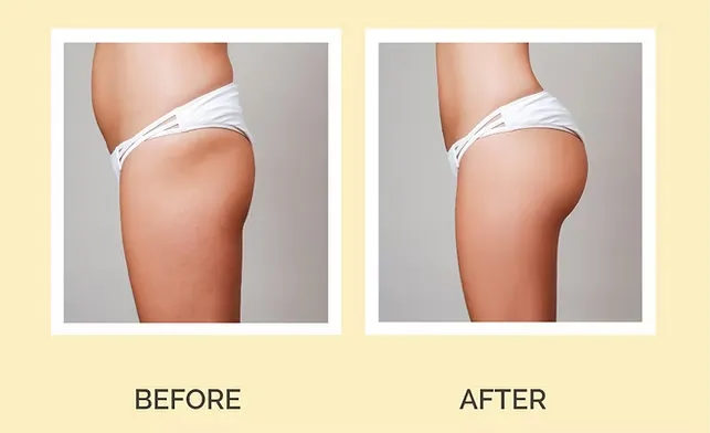 Bum Enhancement 1